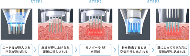 ポテンツァ治療のメカニズム